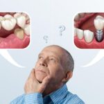 dental implants or bridges