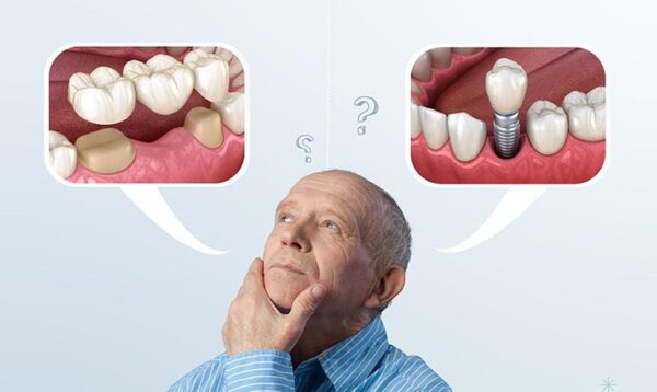 dental implants or bridges
