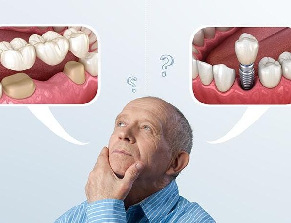 dental implants or bridges