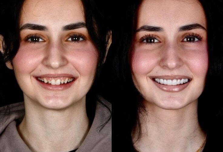 patient did hollywood smile