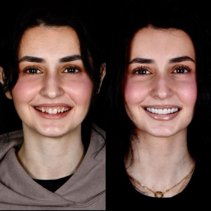 patient did hollywood smile